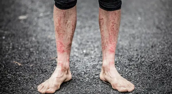 Piernas de corredor con rasguños y enrojecimiento, evidencia de la dureza del Barkley Marathon.